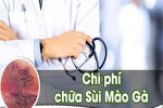 Chi phí hỗ trợ điều trị bệnh sùi mào gà bao nhiêu tiền?
