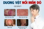 Đầu dương vật nổi mẩn đỏ ngứa – Cảnh giác 8 bệnh nguy hiểm
