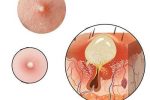 Nổi mụn đầu trắng ở vùng kín nữ giới là bệnh gì? Cách chữa trị