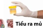 Tiểu buốt có mủ – Dấu hiệu chớ được xem thường