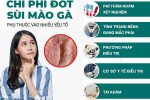 Chi phí đốt sùi mào gà bao nhiêu tiền – Bảng giá chi tiết tại Phòng khám đa khoa Quận 1 HCM